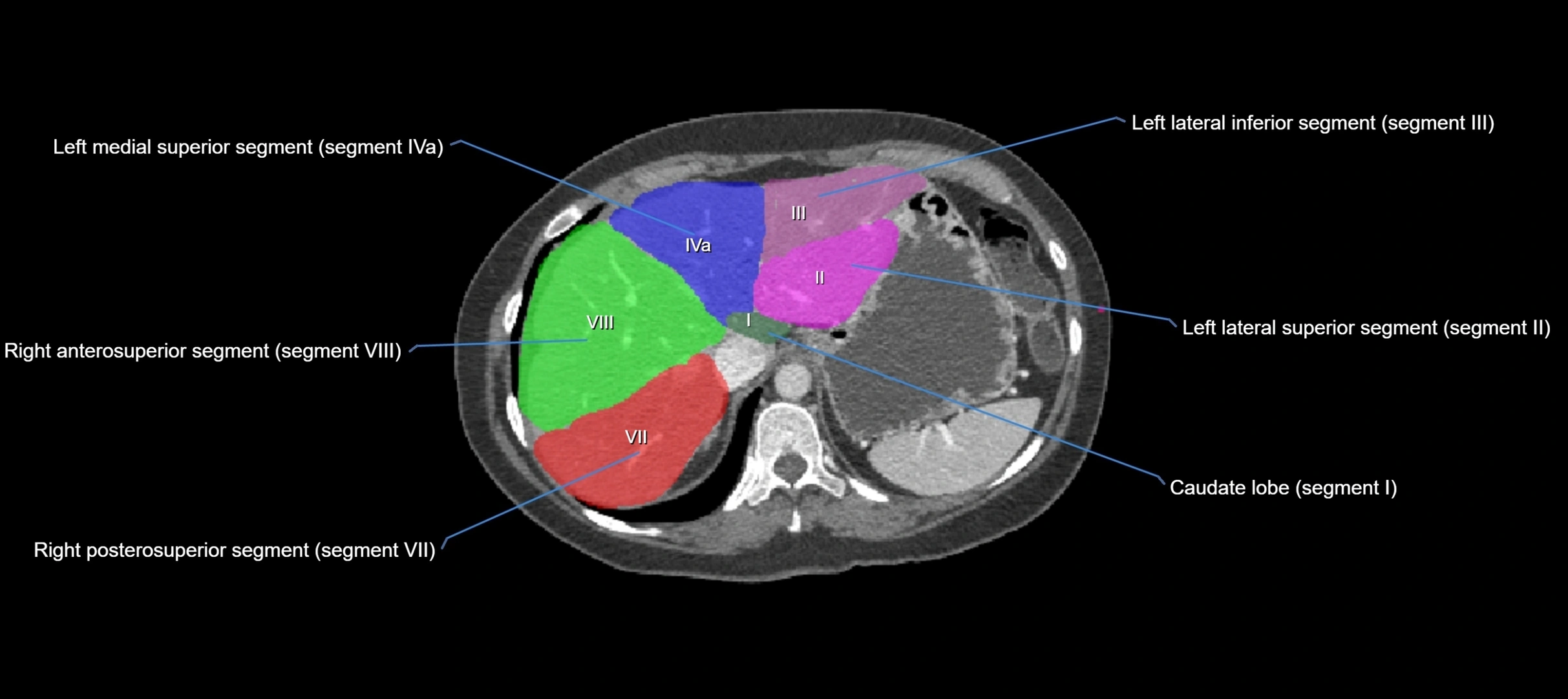 CT liver segments axial cross sectional anatomy labelled image-00057.webp
